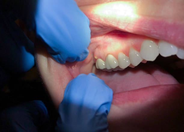 Best Emergency Dentist for Knocked-Out Tooth in East Gaffney, SC